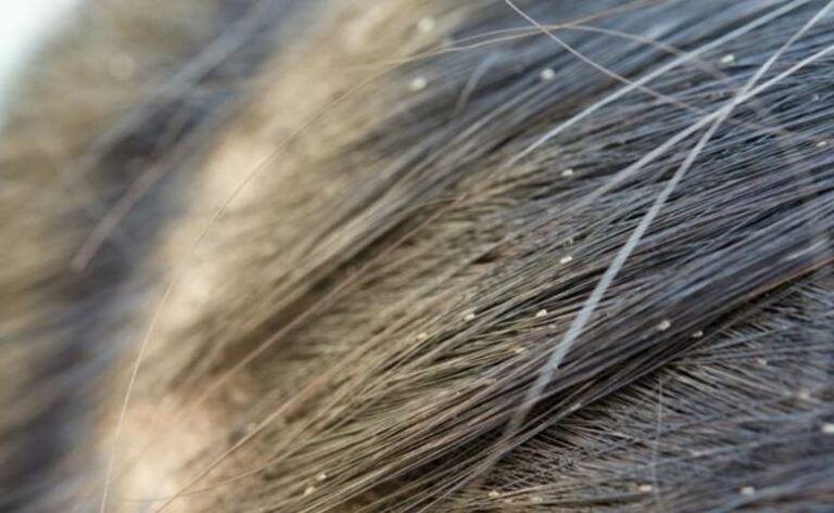 Ketahui Penyebab dan 10 Cara Menghilangkan Kutu Rambut