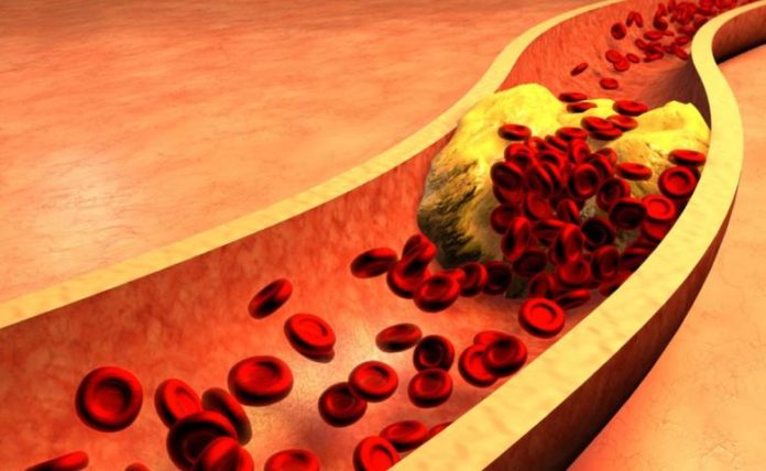 10 Cara Mencegah &amp; Menghindari Penyakit Jantung