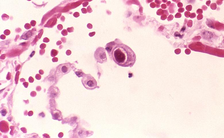 bahaya hiv aids