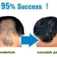 Jual Obat Botak Herbal Tropis Kaya Vitamin E Minyak Kemiri Murah