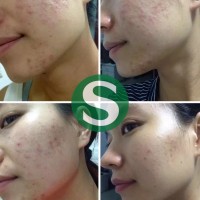 Jual Acne Solution Obat Jerawat Handmade 1000% AMAN dan AMPUH GARANSI Murah