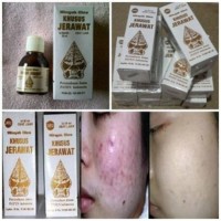SERUM MENGHILANGKAN JERAWAT/Minyak Oles Khusus Jerawat Wayang