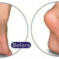 Jual obat penghalus kulit tumit telapak kaki jari kaki pecah kasar Murah