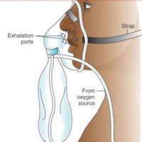 Jual Non Rebreathing Mask Adult / Masker Oksigen Kantung Dewasa / Sungkup -  Kab. Subang - Mada Medika | Tokopedia