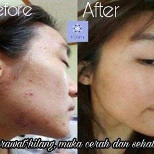 Kosmetik Herbal Alami Menghilangkan Flek Hitam Pada Wajah Tokopedia
