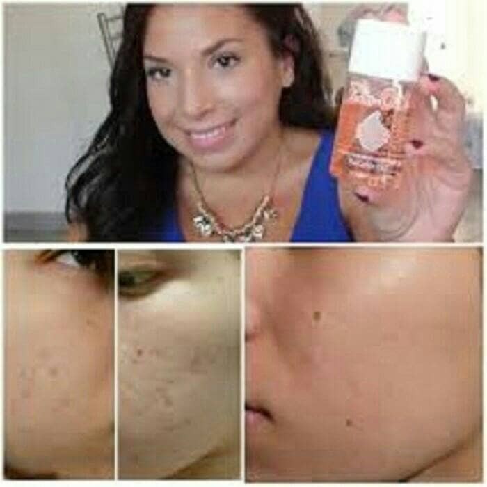 Info Bio Oil Bekas Luka Travelbon.com Info Bio Oil Bekas Luka Travelbon.com