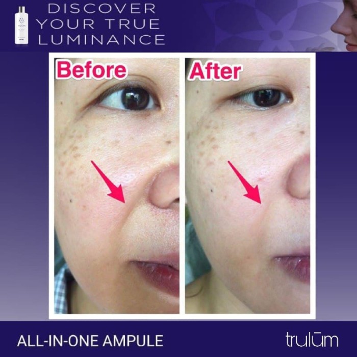 Harga Krim Penghilang Stretch Mark Di Apotik Travelbon.com Harga Krim Penghilang Stretch Mark Di Apotik Travelbon.com