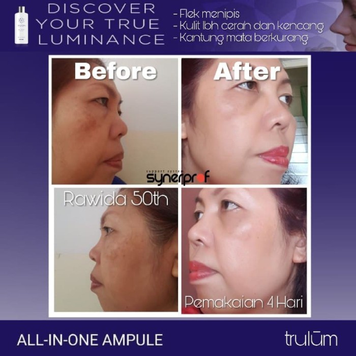 Harga Obat Stretch Mark Di Apotik Travelbon.com Harga Obat Stretch Mark Di Apotik Travelbon.com