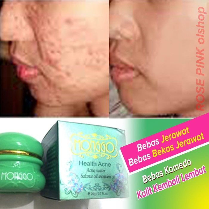Penghilang Jerawat / Pembersih Jerawat / Cream Penghilang Jerawat