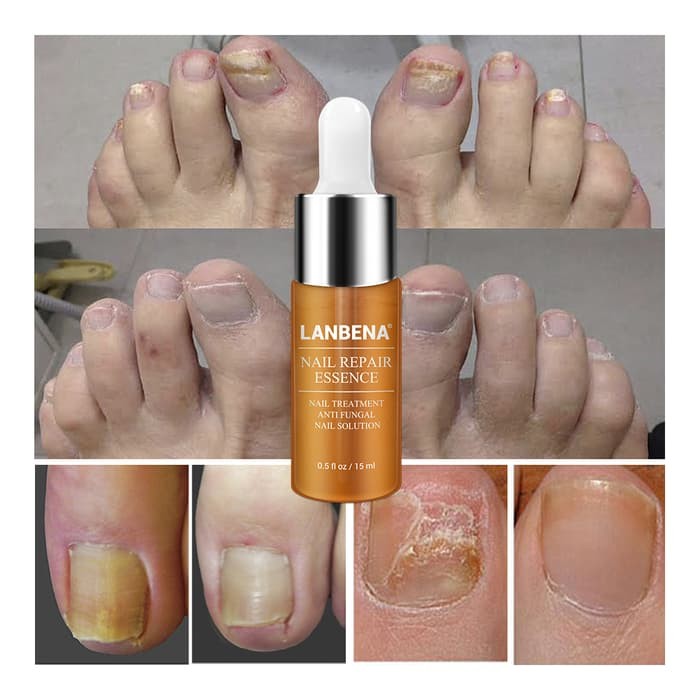 Jual ORIGINAL LANBENA Nail Repair Essence ( serum untuk jamur pada kuku