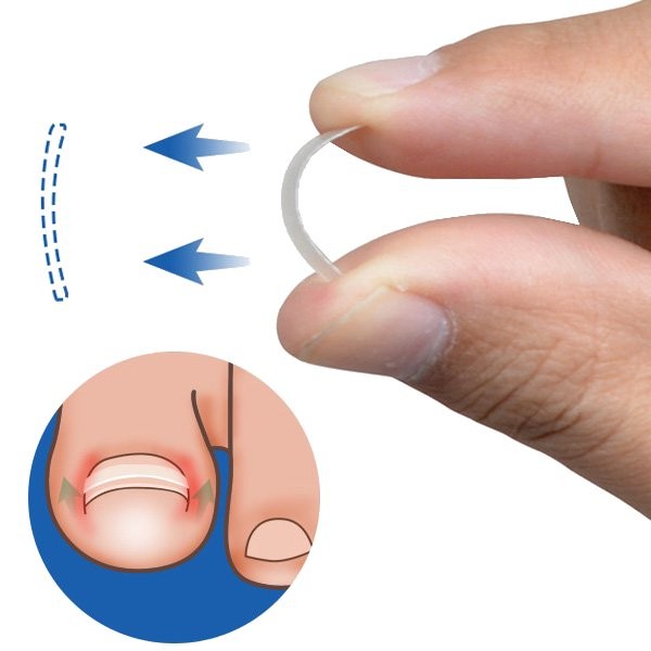 Ingrown Toenail Straightening Clip 