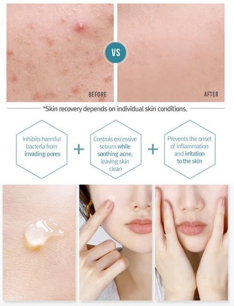 pair acne cream palsu