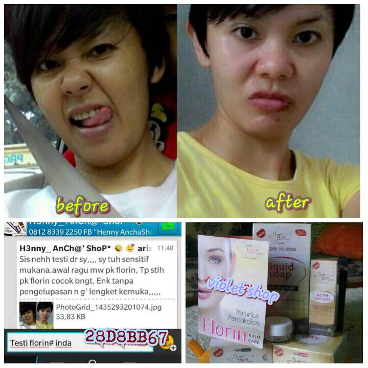 jual florin anti acne florin paket jerawat violet jual florin anti acne florin paket jerawat violet