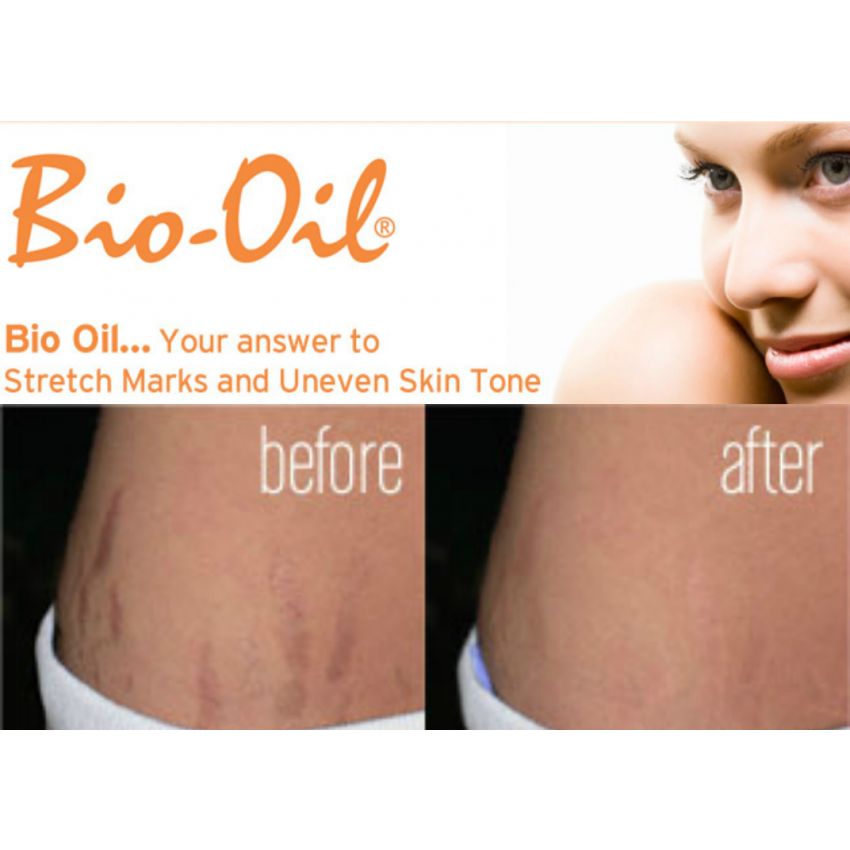 jual bio penghilang bekas luka penghilang jerawat stretchmark memuluskn marlangga jual bio penghilang bekas luka penghilang jerawat stretchmark memuluskn marlangga